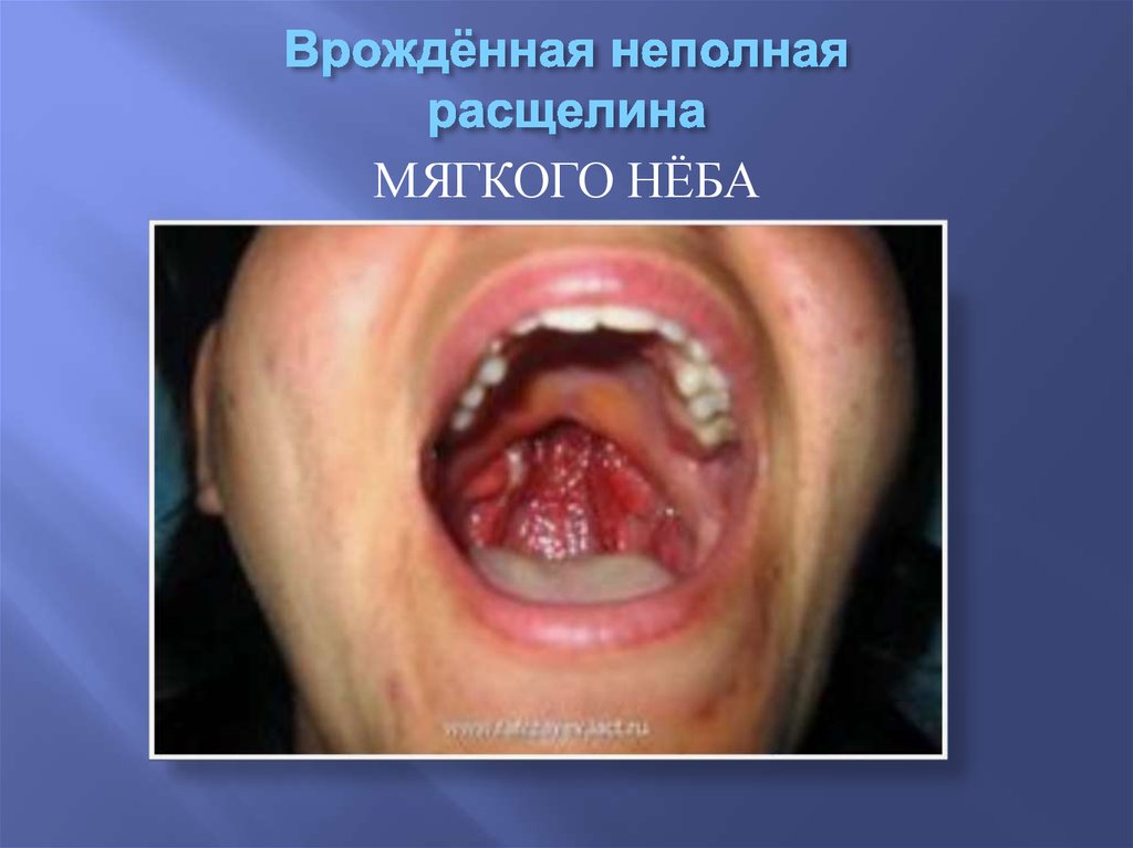 Врождённая неполная расщелина