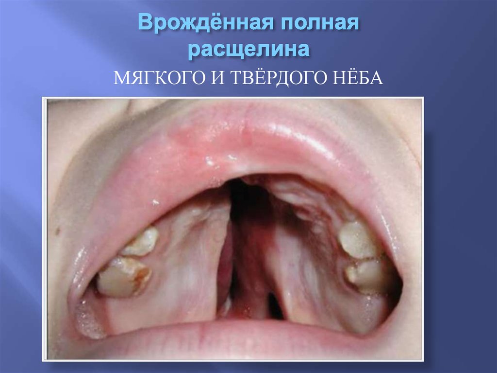 Врождённая полная расщелина