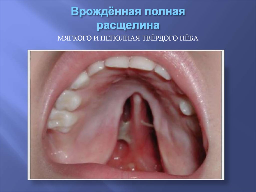 Врождённая полная расщелина
