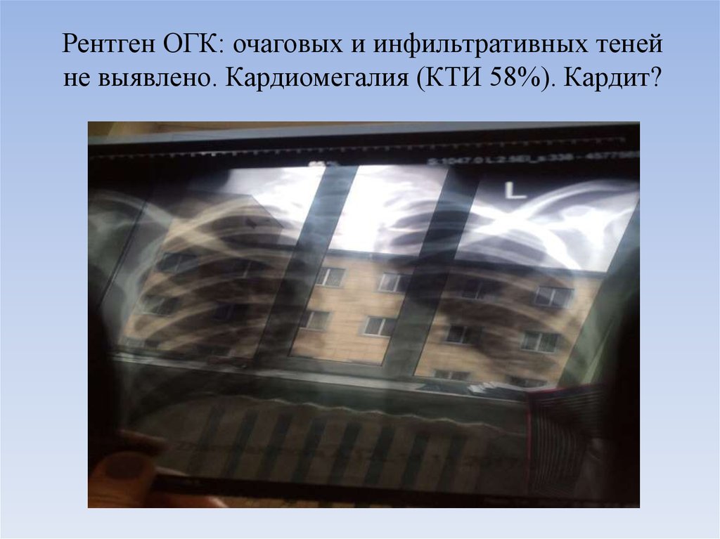 Рентген ОГК: очаговых и инфильтративных теней не выявлено. Кардиомегалия (КТИ 58%). Кардит?