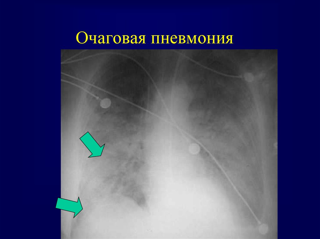 Очаговая пневмония. Очагово сливная пневмония рентген. Очагово-сливная форма пневмонии. Очаговая пневмония справа.