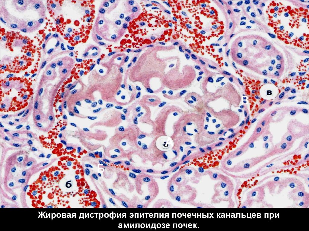 Зернистая дистрофия. Гидропическая дистрофия эпителия почечных канальцев. Гидропическая дистрофия эпителия канальцев почки микропрепарат. Гидропическая дистрофия эпителия канальцев почки макропрепарат. Жировая жировая дистрофия почек.