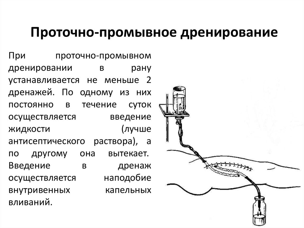 Непрерывный уход. Схема проточно-промывной системы для диализа раны. Схема проточно промывного дренирования. Проточно-промывное дренирование раны. Проточно-аспирационное дренирование.