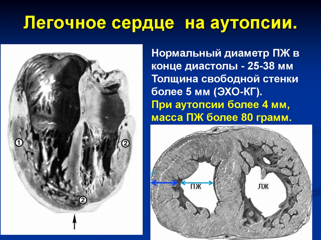 Легочное сердце. Хроническое легочное сердце патанатомия. Легочное сердце макропрепарат. Острое легочное сердце патанатомия. Хроническое легочное сердце патологическая анатомия.