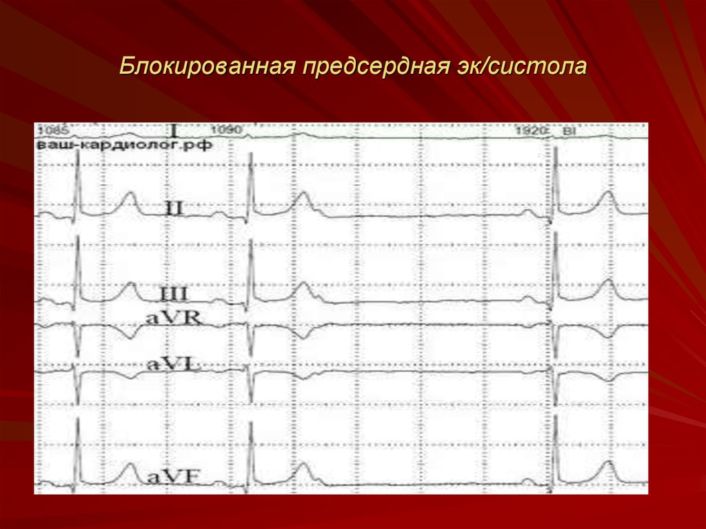 Предсердная блокада. Блокированная предсердная экстрасистола. Блокированные предсердные экстрасистолы на ЭКГ. Блокированные предсердные ЭС. Блокированная предсердная ЭС на ЭКГ.