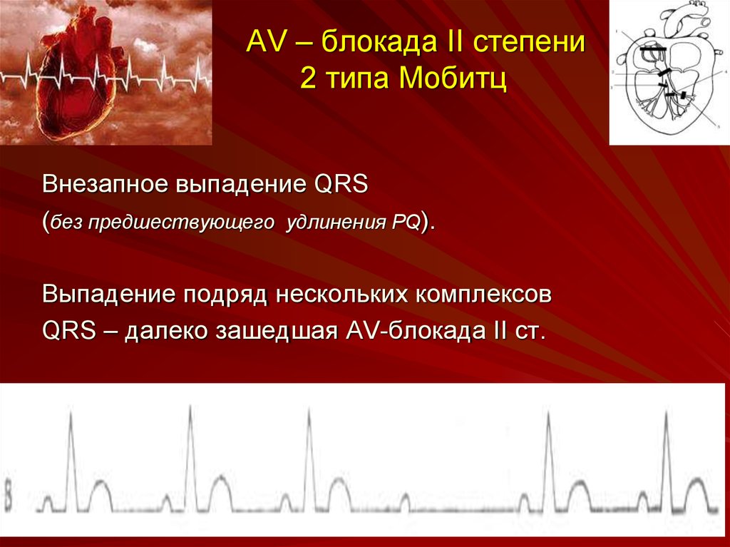 Ав блокада 2 степени. АВ блокада типа Мобитц 2. АВ блокада 2 степени с выпадением QRS. Av - блокада II степени Тип Мобитц. Аритмия АВ блокада 2 степени.