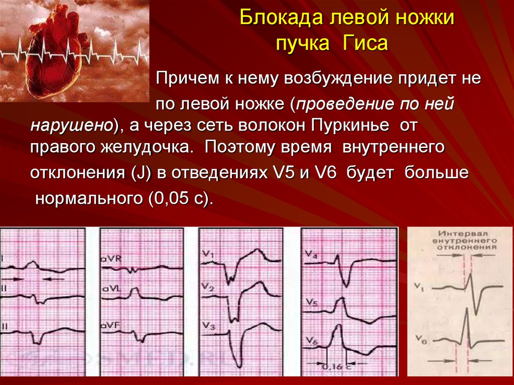 Правой ножки пучка. ЭКГ неполная блокада левой ножки НПГ. Блокада передневерхнего разветвления левой ножки пучка Гиса. Ритм при блокаде левой ножки пучка Гиса. Синусовый ритм с блокадой левой ножки пучка Гиса.