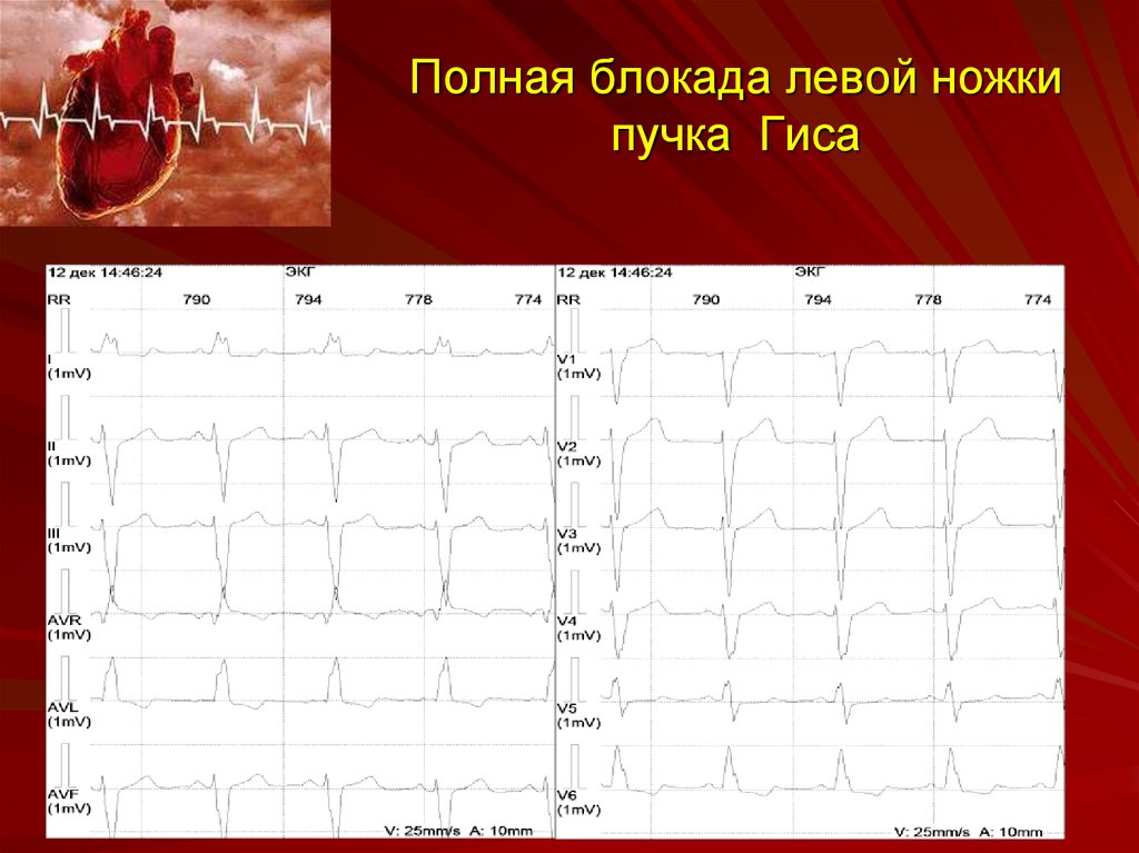 Полная блокада левой ножки гиса