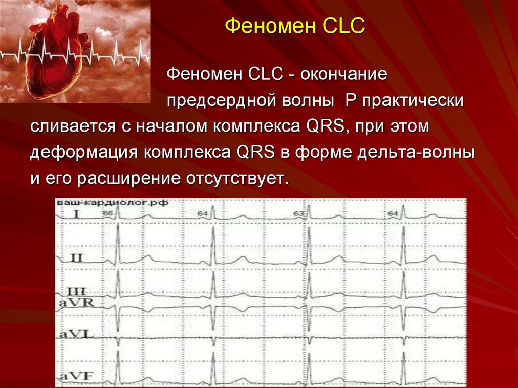 Феномен укороченного pq