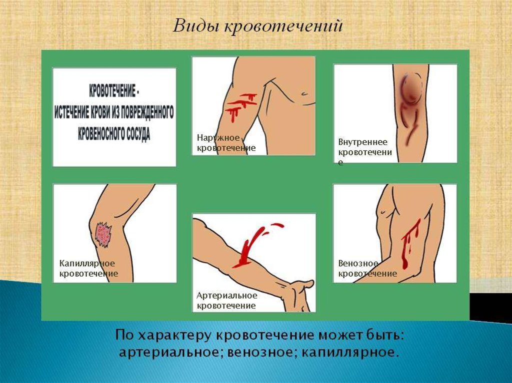 Год кровотечение это что. Артериальное венозное и капиллярное кровотечение. Артериальное,венозное капилляр ое кровотечение. Наружное кровотечение. Типы наружных кровотечений.