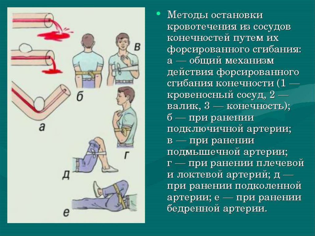 Способы остановки кровотечений презентация