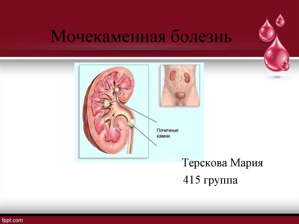 Мочекаменная болезнь осложнения. Мочекаменная болезнь презентация. Мочекаменная болезнь презентация 8 класс. Мочекаменная болезнь картинки для презентации.