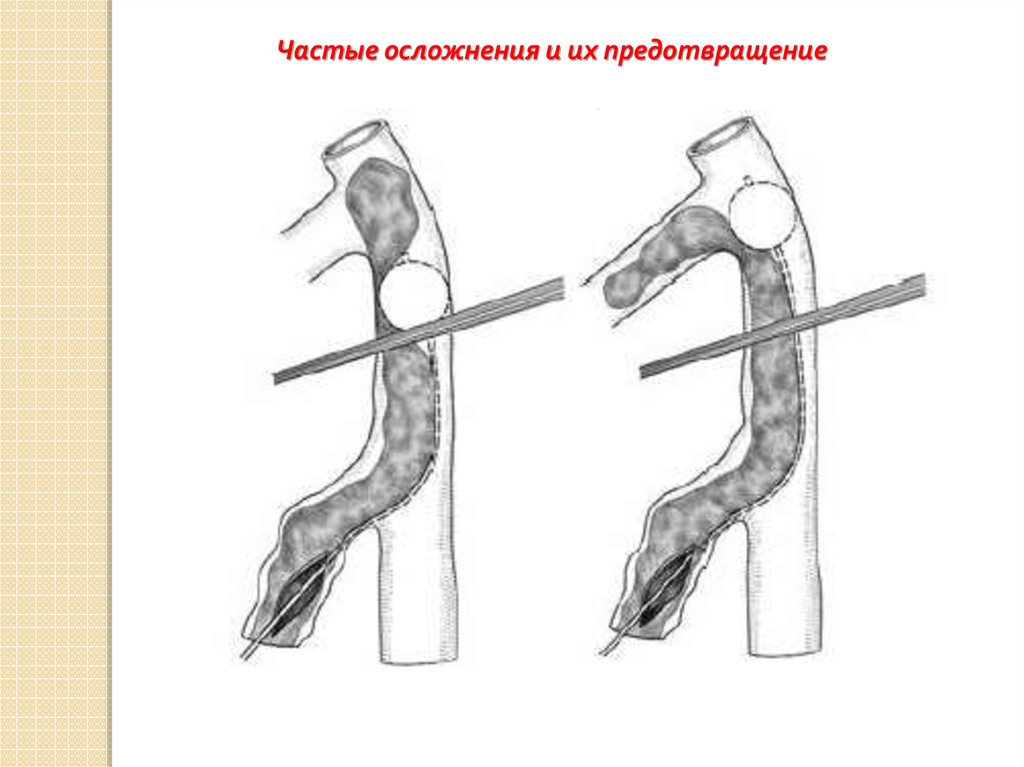 Частые осложнения. Пликация глубоких вен нижних конечностей. Тромбэктомия из глубоких вен нижних конечностей.