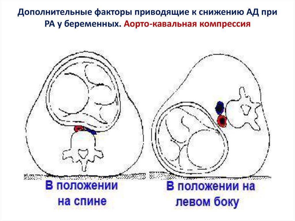 Где находится полая вена у беременных