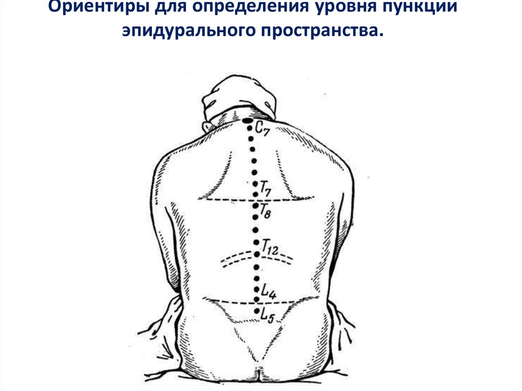 Уровни эпидуральной анестезии. Эпидуральная анестезия уровни ориентиры. Ориентиры при эпидуральной анальгезии. Ориентиры для эпидуральной анестезии. Уровень пункции эпидурального пространства.