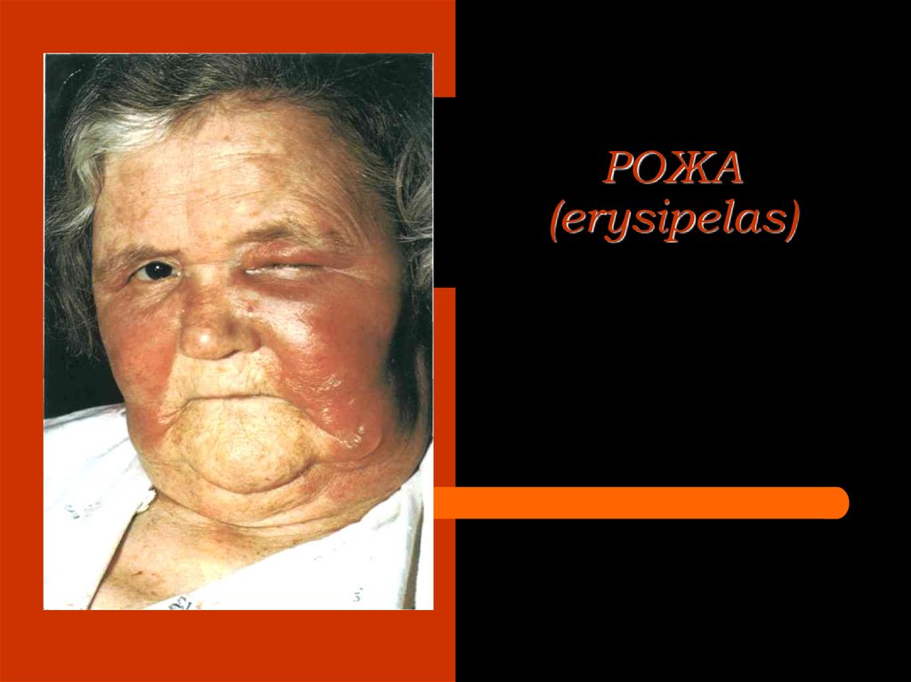 РОЖА (erysipelas)