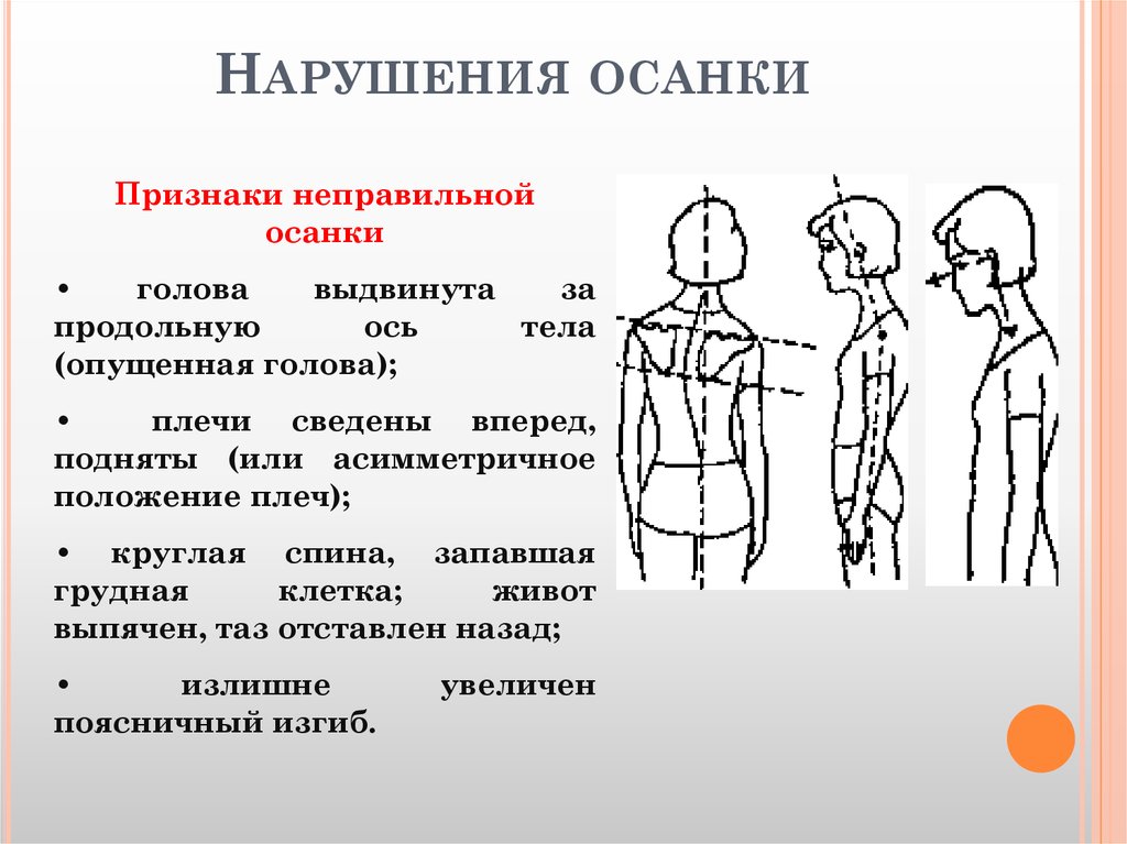 Презентация нарушение осанки