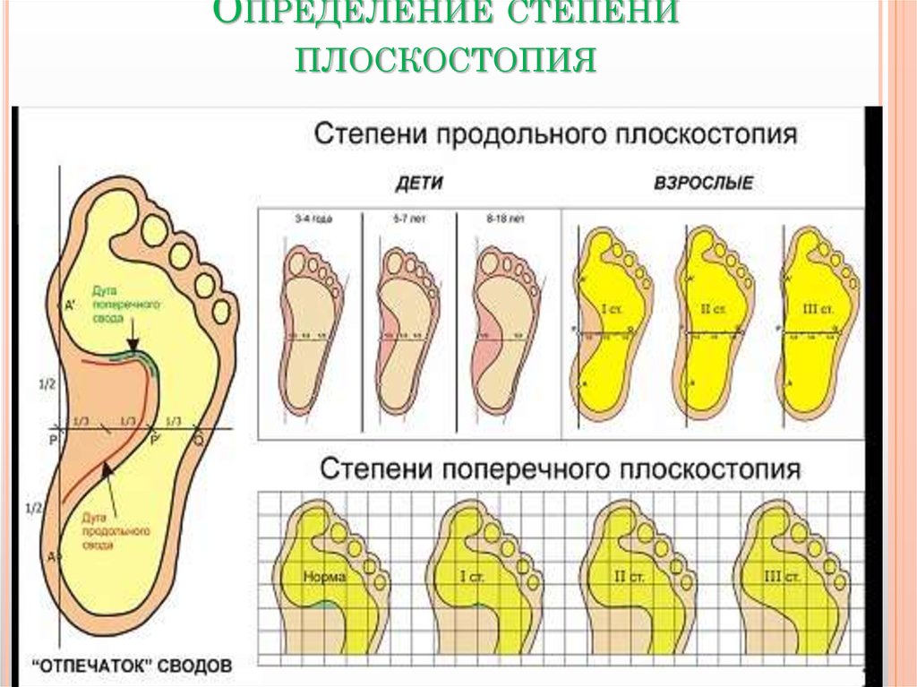 Виды плоскостопия картинки