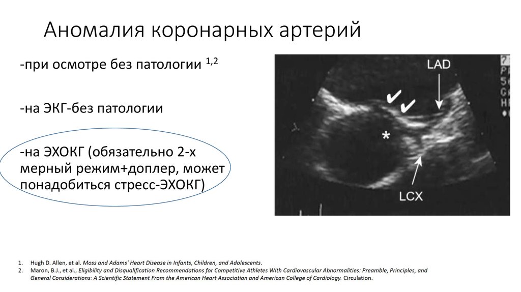 Узи коронарных артерий. Коронарно-легочная фистула на ЭХОКГ. Коронарно-легочная фистула ЭХОКГ допплер. Коронарные артерии на ЭХОКГ. Устья коронарных артерий на эхокардиографии.