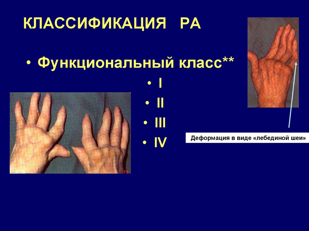 Статистика ревматоидного артрита в россии диаграмма