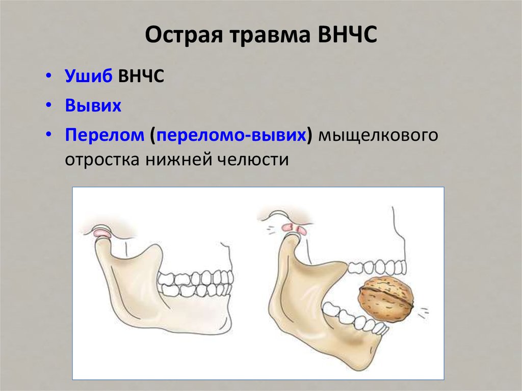 Вывих нижней челюсти презентация