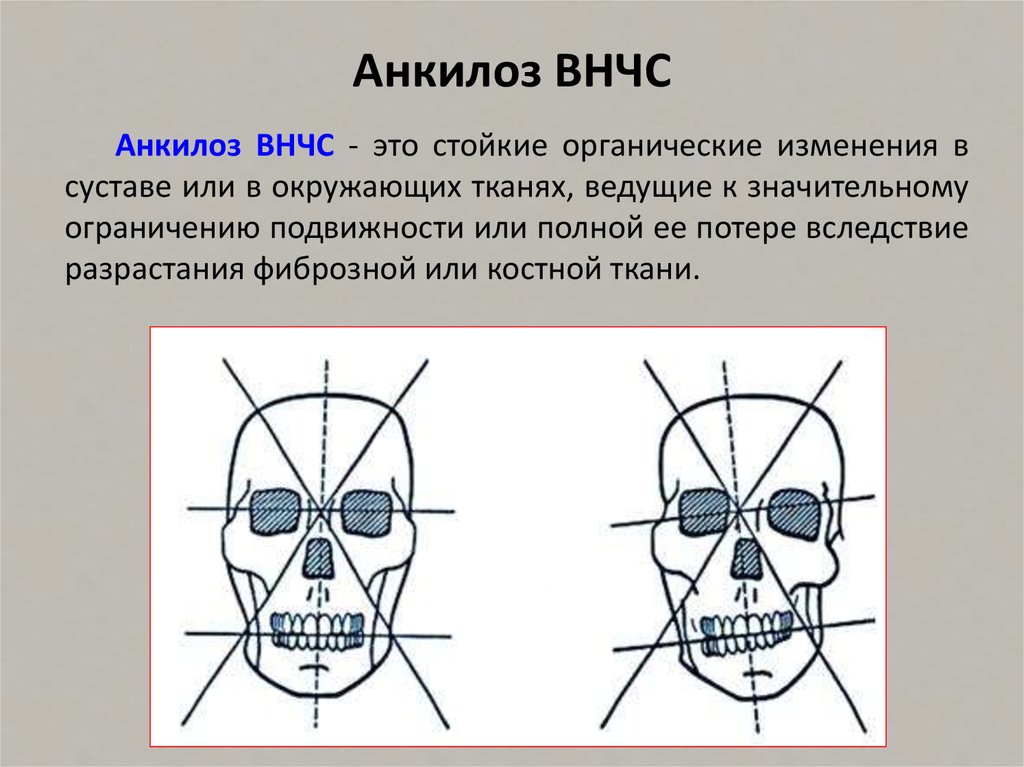 Анкилоз лечение