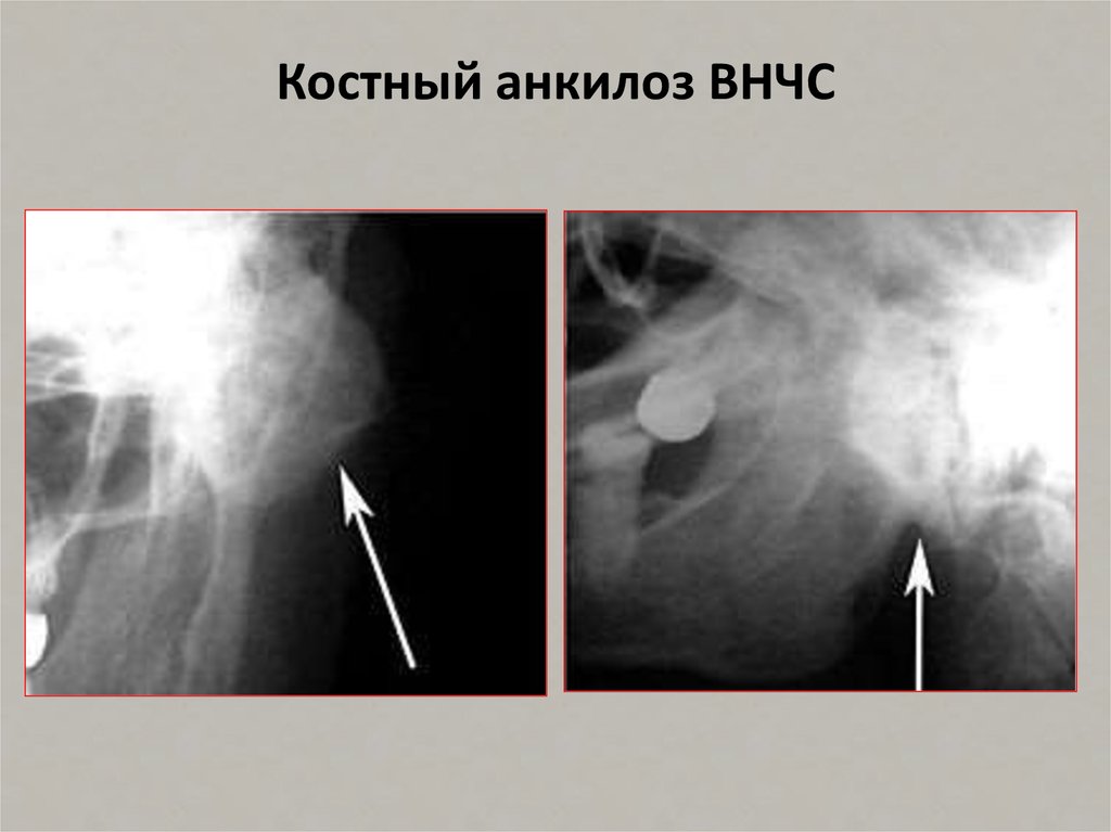 Анкилоз челюсти. Анкилоз сустава рентген.