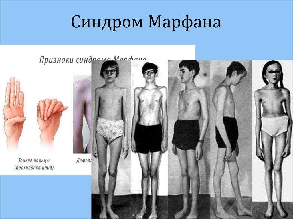 Синдром марфана фото больных