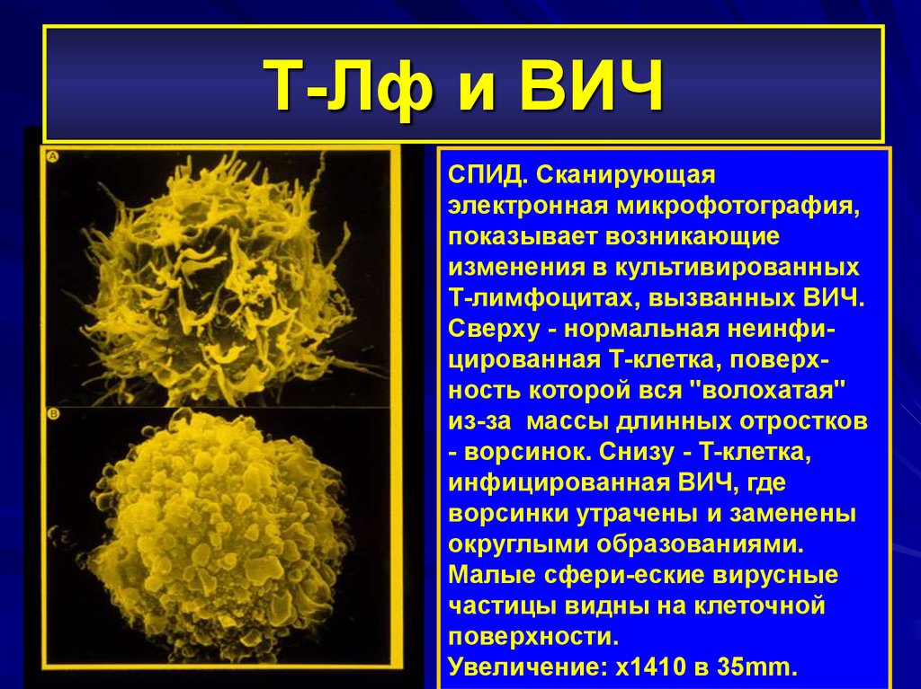 При вич инфекции жидкий стул