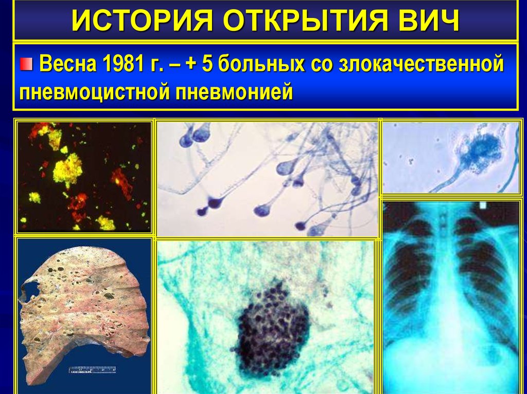 ИСТОРИЯ ОТКРЫТИЯ ВИЧ