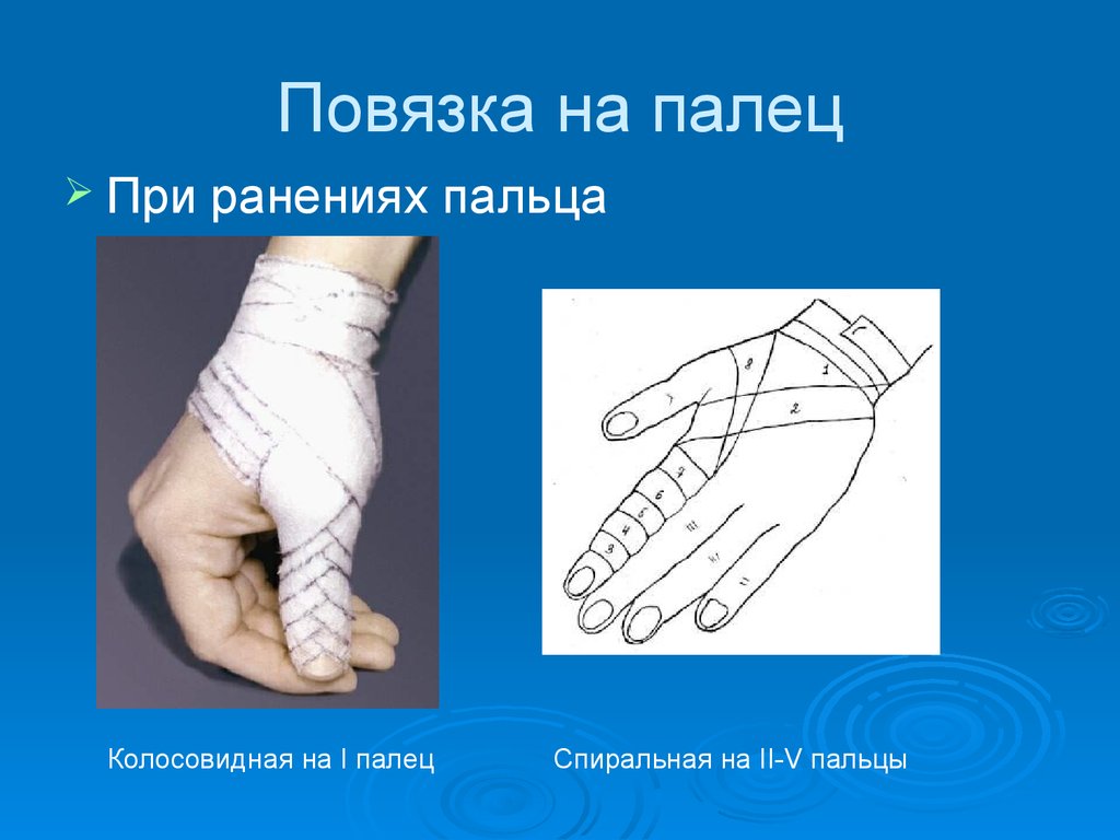 Какая повязка накладывается при повреждении пальца