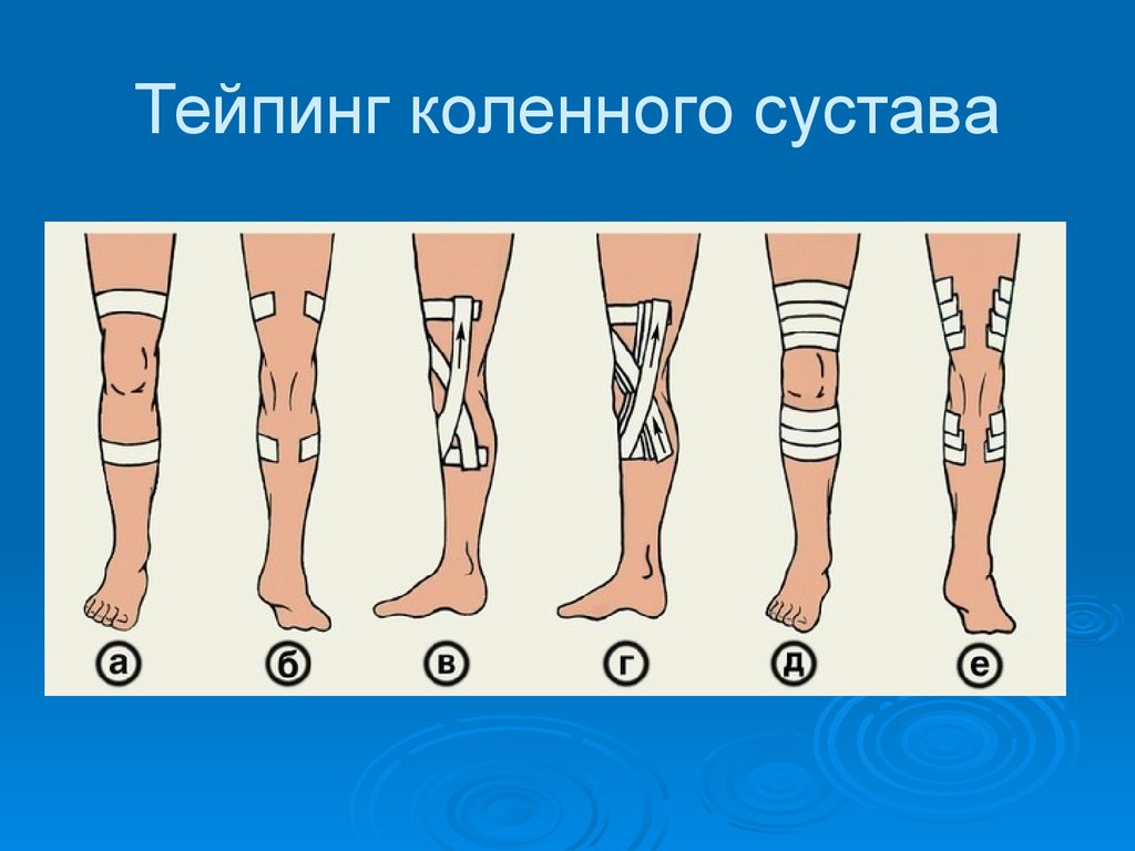 Тейпирование голеностопа при артрозе схема