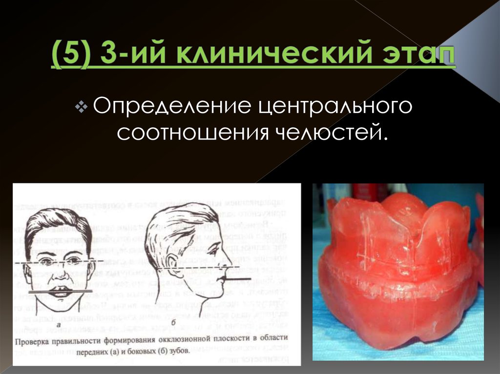 Центральная окклюзия и центральное соотношение. Этапы определения центрального соотношения беззубых челюстей. Определение и фиксация центрального соотношения челюстей. Определение центрального соотношения. Этапы определения центрального соотношения челюстей.