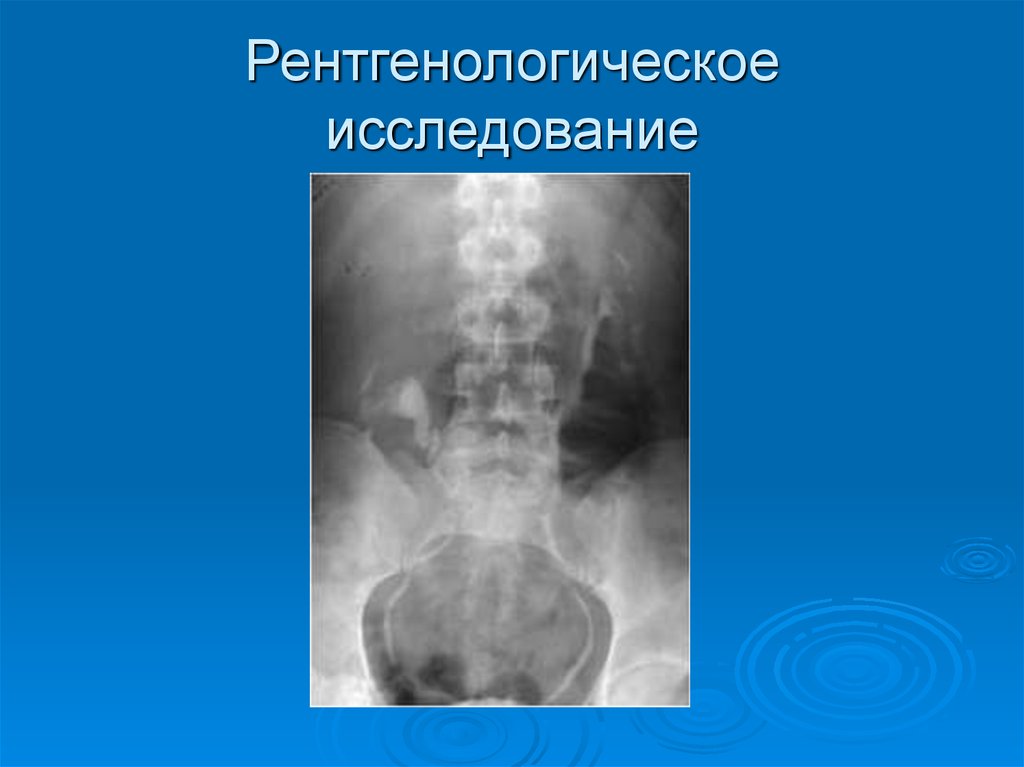 Нефроптоз операция