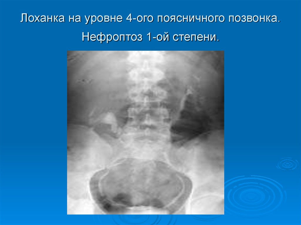 Нефроптоз степени