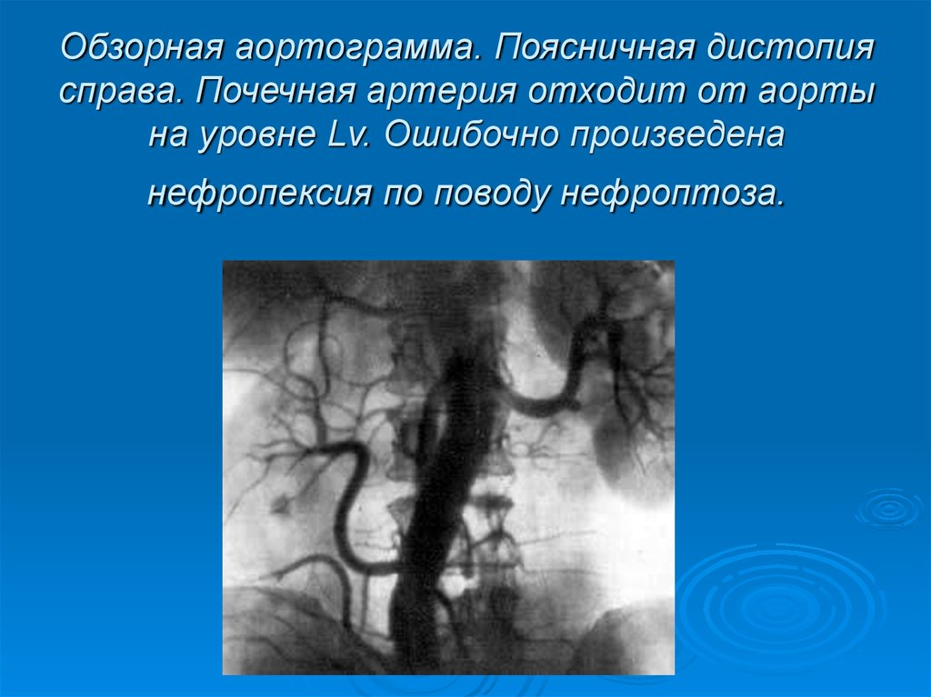 Почечная артерия. Поясничная дистопия почечной артерии. Почечные артерии отходят. Дистопия почечной артерии. Почечная артерия отходит от.