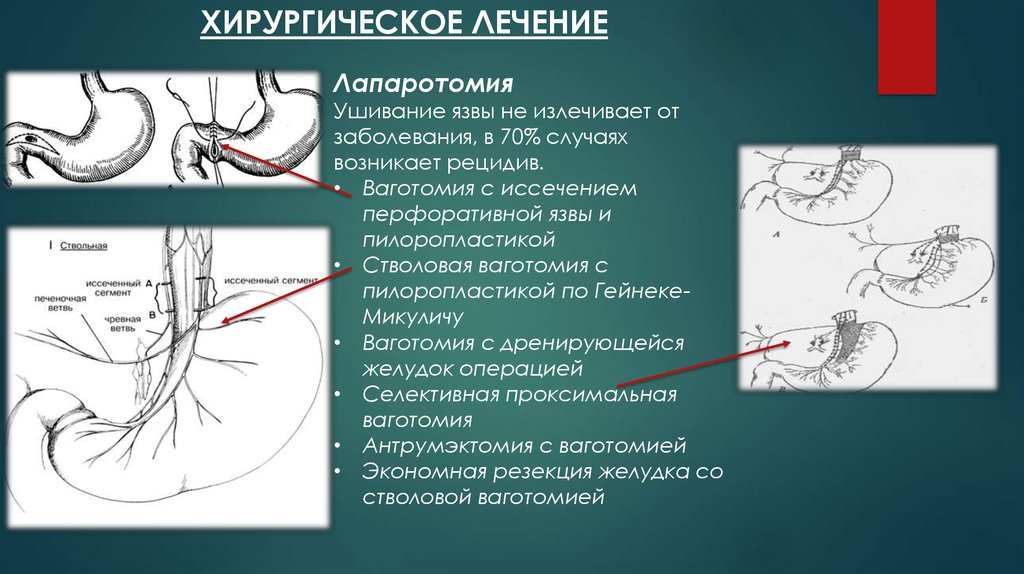 Под этн. Ушивание перфоративной язвы двенадцатиперстной кишки. Селективная ваготомия желудка. Трункулярная ваготомия. Стволовая ваготомия с пилоропластикой.