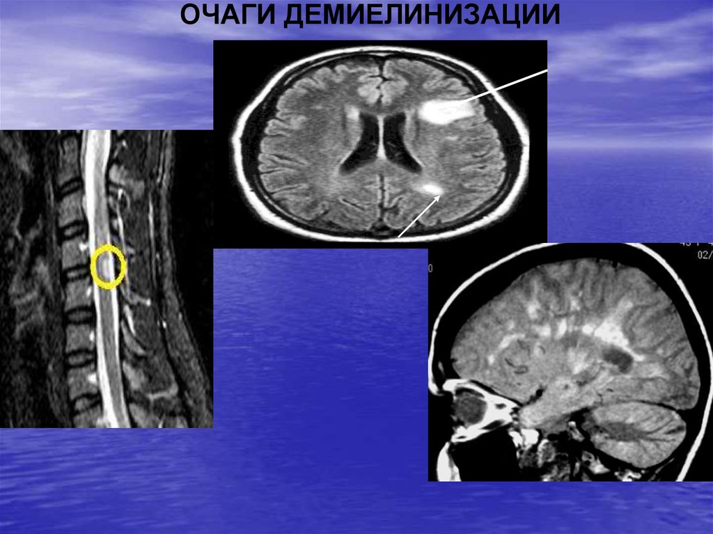 Демиелинизация головного. Демиелинизирующие заболевания головного мозга на мрт. Демиелинизация зрительного нерва на мрт. Демиелинизирующее заболевание ЦНС на мрт. Очаги демиелинизации головного мозга на мрт.
