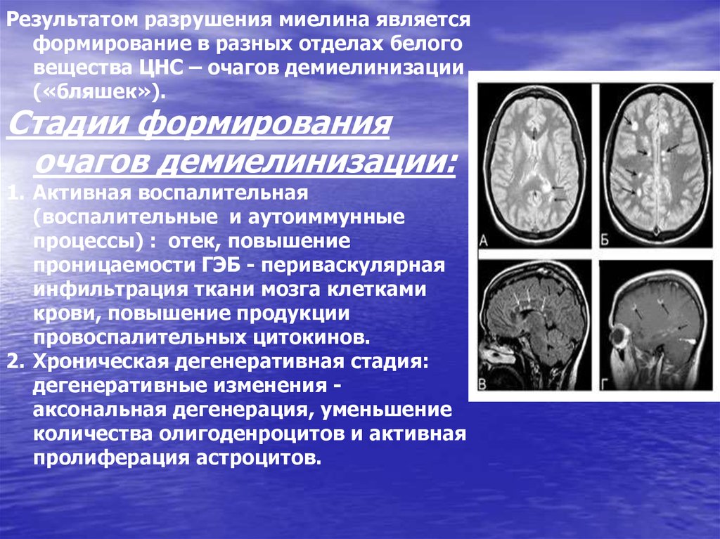 Постишемические изменения мозга. Рассеянный склероз демиелинизация. Очаги демиелинизации головного мозга на мрт. Демиелинизирующие заболевания головного мозга кт. Демиелинизирующий процесс головного мозга что это такое.