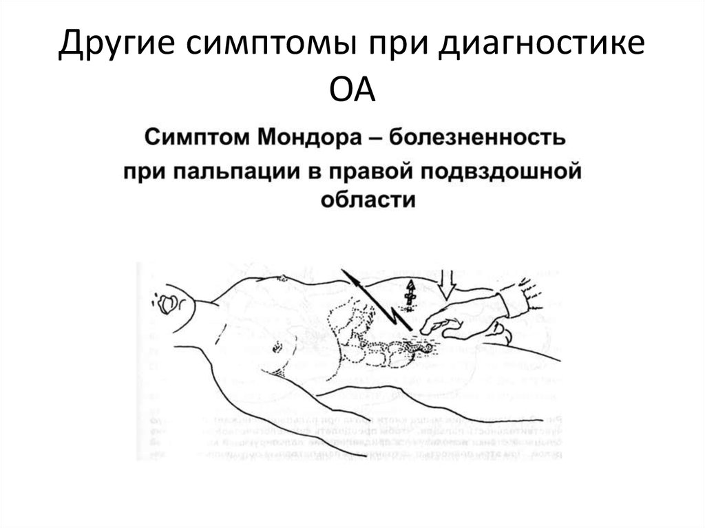 Наиболее типичная клиническая картина острого аппендицита развивается