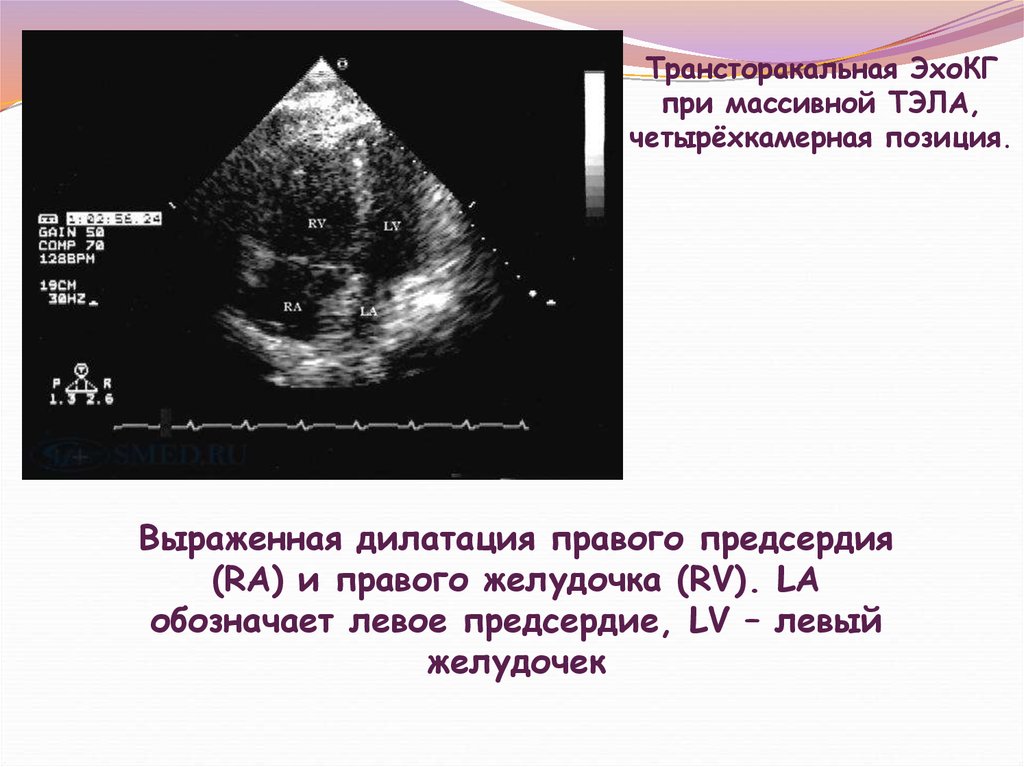 Дилатация левого. Четырехкамерная позиция в ЭХОКГ. Дилатация левого желудочка ЭХОКГ. Левое предсердие ЭХОКГ. ЭХОКГ при Тэла.