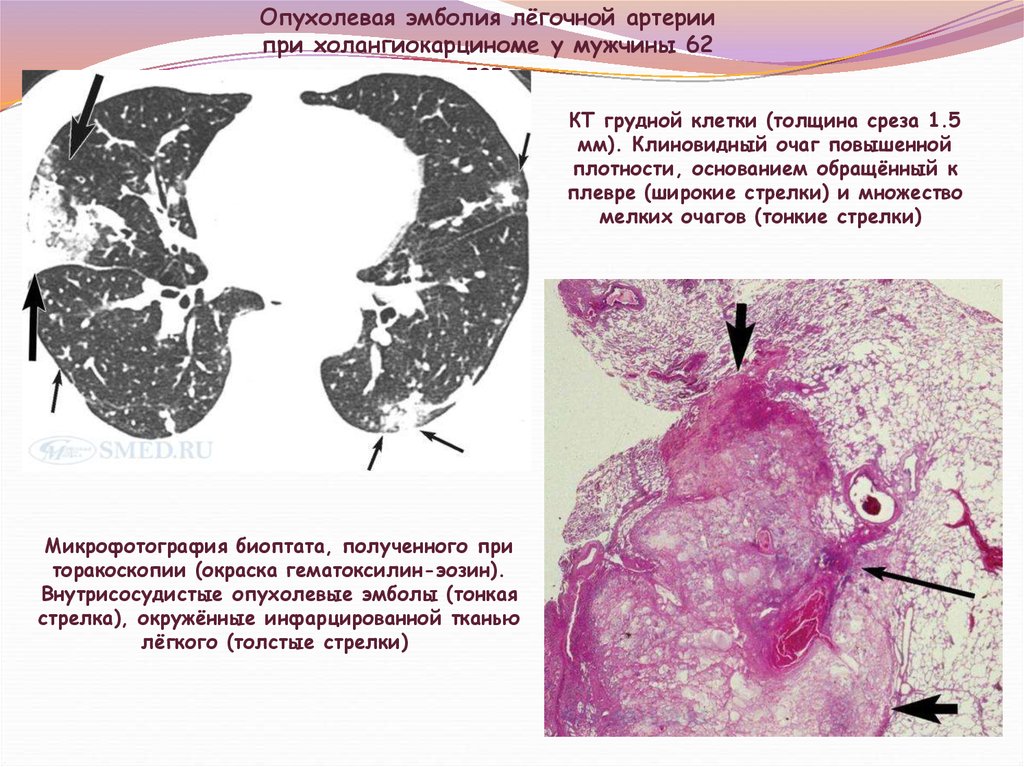 Тромбоэмболия легочной артерии пневмония. Тромбоэмболия легочной артерии микропрепарат. Тромбоэмболия легочной артерии патанатомия. Тромбоэмболия легочной артерии макропрепарат. Тромбоэмболия микропрепарат.