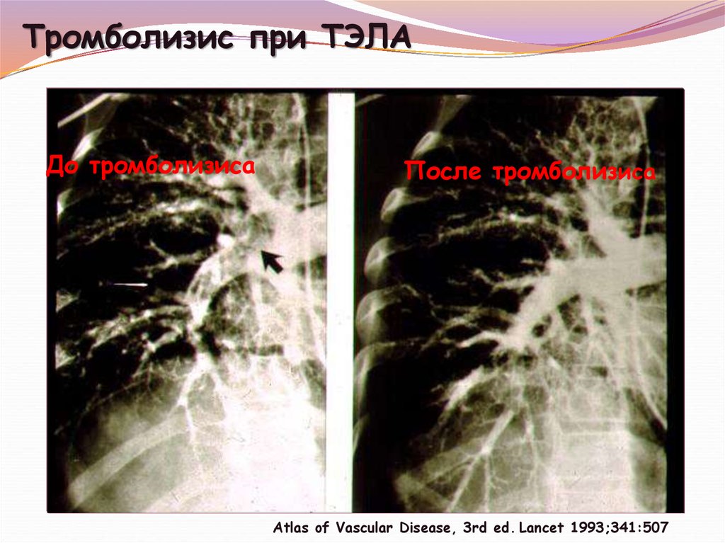 Тромболизис при тромбоэмболии легочной. Тромболизис Тэла. Тромболизис при Тэла. Тромболизис при Тэла рекомендации. Тромболизис Тэла клинические рекомендации.