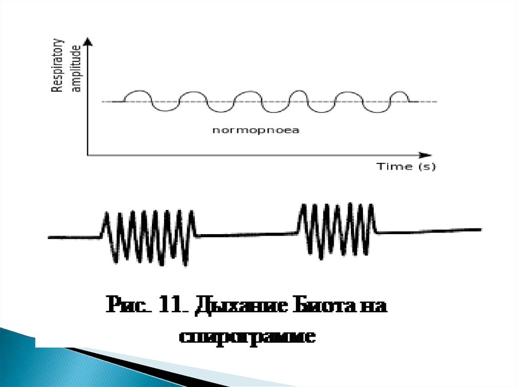 Дыхание чейна стокса схема