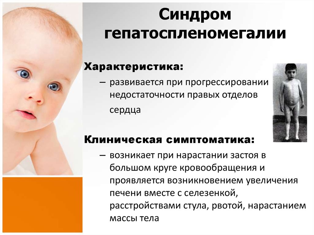 Селезенка у новорожденных. Синдром гепатоспленомегалии. Клинические проявления гепатоспленомегалии. Гепатоспленомегалия характерна для. Синдром гепатоспленомегалии у детей.