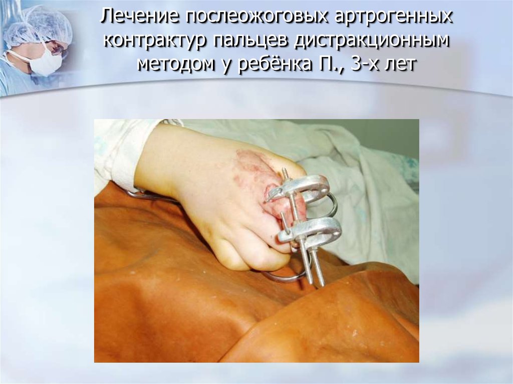 Лечение послеожоговых артрогенных контрактур пальцев дистракционным методом у ребёнка П., 3-х лет