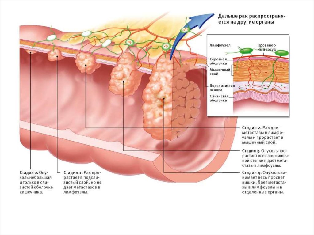 Стадии рака кишечника. Предраковые состояния толстой кишки. Полипы прямой кишки классификация.