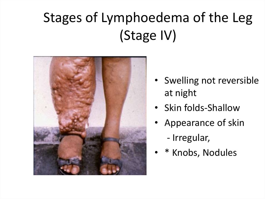 Different Stages Of Lymphoedema Lymphedema Lymphoedema Lymphedema Leg ...