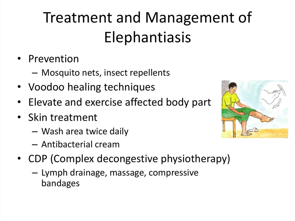 Elephantiasis Causes Symptoms And Treatment 8805