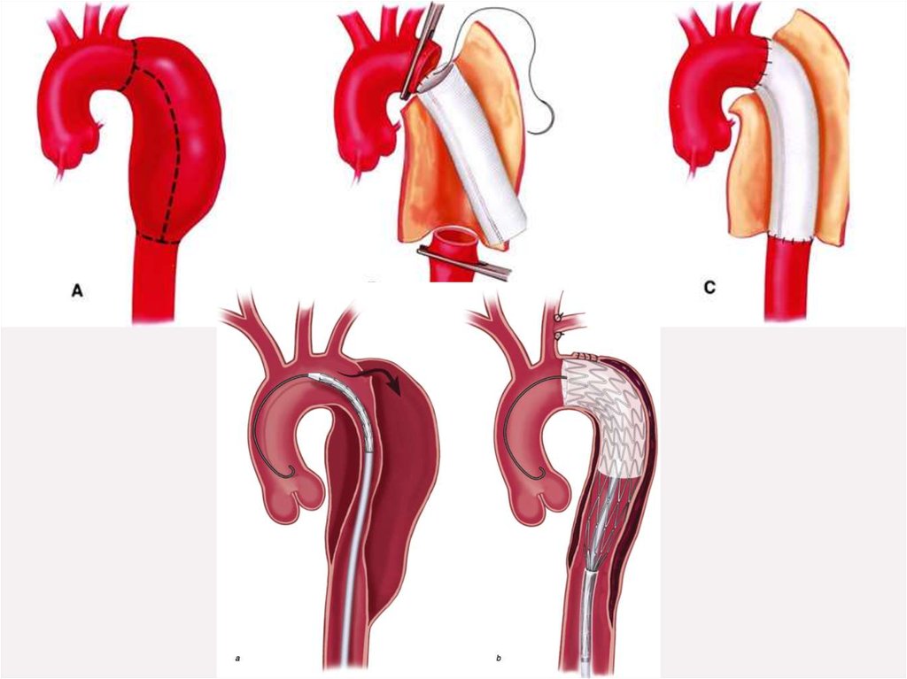 Аневризмы аорты презентация